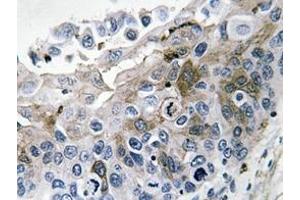 Immunohistochemistry analysis of IL-1B Antibody in paraffin-embedded human lung carcinoma tissue. (IL-1 beta Antikörper)