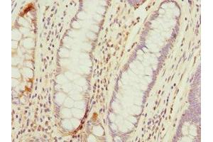 Immunohistochemistry of paraffin-embedded human colon cancer using ABIN7172974 at dilution of 1:100 (TMED1 Antikörper  (AA 35-190))