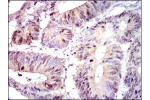 Figure5: Immunohistochemical analysis of paraffin-embedded colon cancer tissues using PBK mouse mAb with DAB staining.
