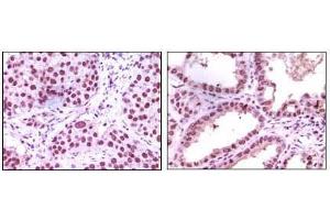 Immunohistochemical analysis of paraffin-embedded human lung carcinoma (left) and kidney carcinoma (right), showing nuclear localization using LSD1 mouse mAb with DAB staining. (LSD1 Antikörper)