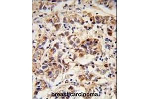 Formalin-fixed and paraffin-embedded human breast carcinoma reacted with SPRR1B Antibody (C-term), which was peroxidase-conjugated to the secondary antibody, followed by DAB staining. (SPRR1B Antikörper  (C-Term))
