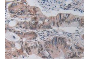 IHC-P analysis of Mouse Rectum Cancer Tissue, with DAB staining. (FLIP Antikörper  (AA 210-460))