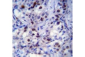 Rb antibody immunohistochemistry analysis in formalin fixed and paraffin embedded human breast carcinoma.