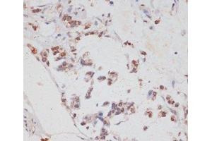 Immunohistochemistry of paraffin-embedded Human gastric cancer using HTATSF1 Polyclonal Antibody at dilution of 1:100 (40x lens). (HTATSF1 Antikörper)
