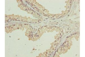 Immunohistochemistry of paraffin-embedded human prostate cancer using ABIN7175806 at dilution of 1:100