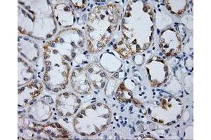 Immunohistochemical staining of paraffin-embedded Carcinoma of prostate tissue using anti-LIPG mouse monoclonal antibody. (LIPG Antikörper)