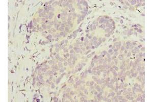 Immunohistochemistry of paraffin-embedded human gastric cancer using ABIN7175802 at dilution of 1:100 (WDR89 Antikörper  (AA 1-387))