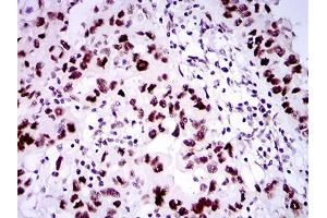 Immunohistochemical analysis of paraffin-embedded endometrial cancer tissues using TP53BP1 mouse mAb with DAB staining.