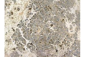ABIN6263874 and ABIN6272758 at 1/100 staining human melanoma by IHC-P.
