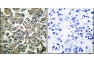 Immunohistochemistry analysis of paraffin-embedded human breast carcinoma, using WNK1 (Phospho-Thr58) Antibody. (WNK1 Antikörper  (pThr60))