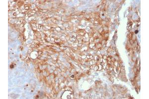 Formalin-fixed, paraffin-embedded human Urothelial Carcinoma stained with Uroplakin 1A Mouse Monoclonal Antibody (UPK1A/2925). (UPK1A Antikörper  (AA 114-173))