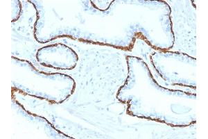Formalin-fixed, paraffin-embedded human Prostate Carcinoma stained with Cytokeratin 5 (KRT5) Mouse Monoclonal Antibody (KRT5/2080).