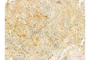 ABIN6263748 and ABIN6279343 at 1/100 staining human lung squamous cell carcinoma by IHC-P. (NT5C2 Antikörper  (Internal Region))