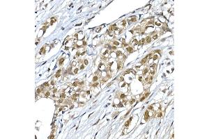 Immunohistochemistry of paraffin-embedded human breast cancer using SNRPD1 Rabbit pAb (ABIN7270363) at dilution of 1:50 (40x lens).