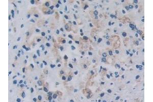 Detection of RARS in Human Prostate cancer Tissue using Polyclonal Antibody to Arginyl tRNA Synthetase (RARS) (RARS Antikörper  (AA 1-146))