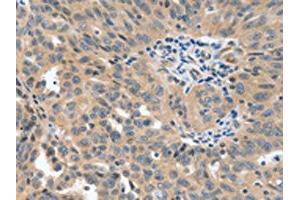 The image on the left is immunohistochemistry of paraffin-embedded Human ovarian cancer tissue using ABIN7191763(P2RY6 Antibody) at dilution 1/40, on the right is treated with synthetic peptide. (P2RY6 Antikörper)