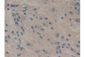 Detection of DKK1 in Human Glioma Tissue using Monoclonal Antibody to Dickkopf Related Protein 1 (DKK1)