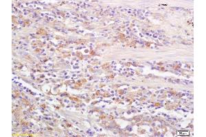 Formalin-fixed and paraffin embedded human lung carcinoma labeled with Rabbit Anti CD69/CLEC2C/AIM Polyclonal Antibody, Unconjugated (ABIN741150) at 1:200 followed by conjugation to the secondary antibody and DAB staining (CD69 Antikörper  (AA 101-199))