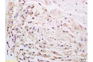 Formalin-fixed and paraffin embedded human gastric carcinoma labeled with Anti-Wnt1 Polyclonal Antibody, Unconjugated (ABIN733748) at 1:200 followed by conjugation to the secondary antibody and DAB staining.
