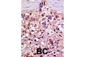 Formalin-fixed and paraffin-embedded human cancer tissue reacted with UBA1 polyclonal antibody  , which was peroxidase-conjugated to the secondary antibody, followed by AEC staining. (UBA1 Antikörper  (C-Term))