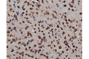 ABIN6269160 at 1/200 staining human lymph cancer tissue sections by IHC-P. (H2AFX Antikörper)