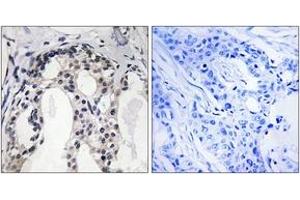 Immunohistochemistry analysis of paraffin-embedded human breast carcinoma, using Merlin (Phospho-Ser10) Antibody. (Merlin Antikörper  (pSer10))