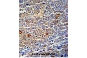C9orf156 Antibody (C-term) (ABIN390925 and ABIN2841127) immunohistochemistry analysis in formalin fixed and paraffin embedded human skin carcinoma followed by peroxidase conjugation of the secondary antibody and DAB staining. (C9orf156 Antikörper  (C-Term))