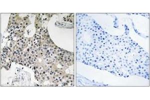 Immunohistochemistry analysis of paraffin-embedded human breast carcinoma tissue, using GPSN2 Antibody.
