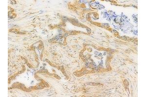 ABIN6262407 and ABIN6276441 at 1/100 staining human pancreatic carcinoma by IHC-P. (GRP94 Antikörper  (C-Term))