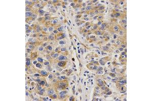 Immunohistochemistry of paraffin-embedded human liver cancer using VAPB Antibody. (VAPB Antikörper)