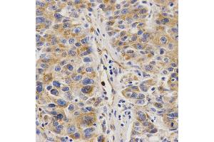 Immunohistochemistry of paraffin-embedded human liver cancer using VAPB Antibody.
