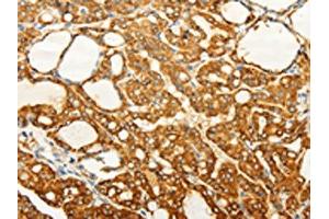The image on the left is immunohistochemistry of paraffin-embedded Human thyroid cancer tissue using ABIN7190727(FZD6 Antibody) at dilution 1/60, on the right is treated with synthetic peptide. (FZD6 Antikörper)