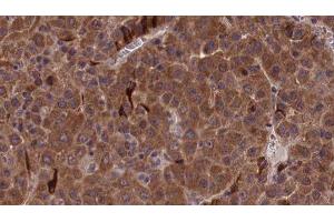 ABIN6277155 at 1/100 staining Human liver cancer tissue by IHC-P.