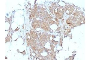 Formalin-fixed, paraffin-embedded human breast carcinoma stained with Major Vault Protein antibody (1032). (MVP Antikörper)
