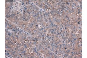 Immunohistochemical staining of paraffin-embedded Adenocarcinoma of colon using anti-Trim33 (ABIN2452534) mouse monoclonal antibody. (TRIM33 Antikörper  (AA 887-1046))