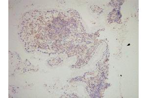SNAI2 Antibody(ABIN6276471) staining human cervical carcinoma tissue sections by IHC-f at 1:200. (SLUG Antikörper  (Internal Region))