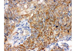 Anti- Bag3 Picoband antibody, IHC(P) IHC(P): Human Lung Cancer Tissue