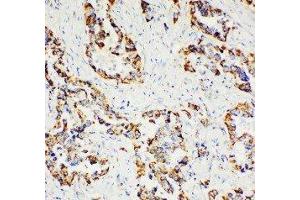 Anti-Paxillin antibody, IHC(P) IHC(P): Human Lung Cancer Tissue (Paxillin Antikörper  (C-Term))