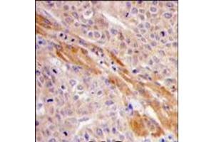 Formalin-fixed and paraffin-embedded human hepatocarcinoma tissue reacted with PGK1 Antibody (Center), which was peroxidase-conjugated to the secondary antibody, followed by DAB staining. (PGK1 Antikörper  (Middle Region))