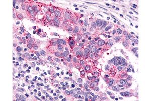 Anti-GRM6 / MGLUR6 antibody IHC of human Ovary, Carcinoma. (Metabotropic Glutamate Receptor 6 Antikörper  (N-Term))