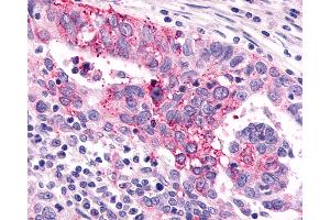 Anti-GRM6 / MGLUR6 antibody IHC of human Ovary, Carcinoma.