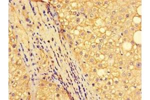 Immunohistochemistry of paraffin-embedded human liver cancer using ABIN7161893 at dilution of 1:100 (NR1D1 Antikörper  (AA 246-558))