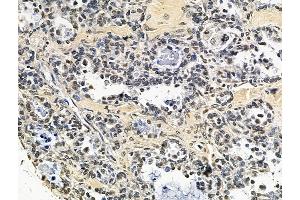 ABIN7096693 and ABIN7100758 at 1/100 staining human ovarian cancer by IHC-P.
