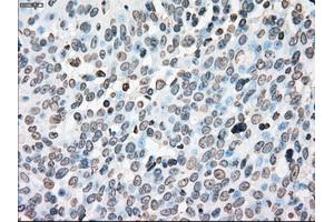 Immunohistochemical staining of paraffin-embedded Adenocarcinoma of colon tissue using anti-PLK1mouse monoclonal antibody. (PLK1 Antikörper)