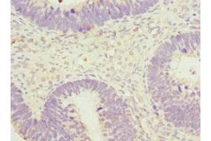 Immunohistochemistry of paraffin-embedded human ovarian cancer using ABIN7170599 at dilution of 1:100 (Spindlin 1 Antikörper  (AA 1-262))