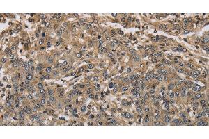 Immunohistochemistry of paraffin-embedded Human liver cancer using KCNA7 Polyclonal Antibody at dilution of 1:40 (KCNA7 Antikörper)