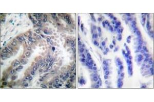 Immunohistochemistry analysis of paraffin-embedded human lung carcinoma tissue, using Caspase 8 (Ab-347) Antibody. (Caspase 8 Antikörper  (AA 313-362))