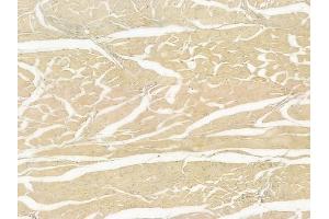 ABIN6266279 and ABIN6277274 at 1/100 staining human tongue carcinoma by IHC-P.