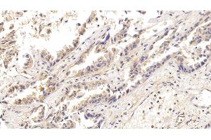 Detection of ACO1 in Human Lung cancer Tissue using Polyclonal Antibody to Aconitase 1 (ACO1) (Aconitase 1 Antikörper  (AA 26-243))