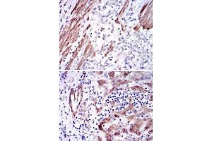 Immunohistochemical analysis of paraffin-embedded human rectum cancer (upper) and human liver cancer (bottom) tissues using GSTM1 monoclonal antibody, clone 1H4A4  with DAB staining.
